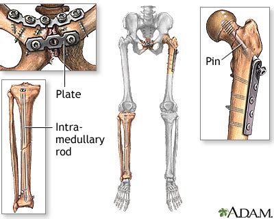 metal bracket in femur bone|Bone Fracture Repair: Procedure, Preparation, and .